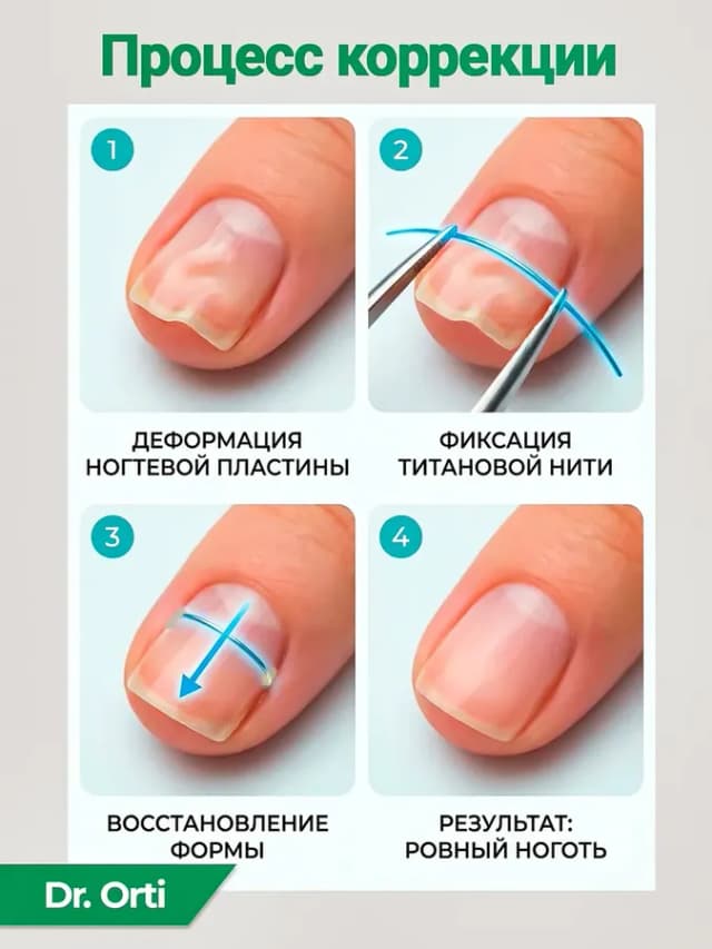 Титановая нить для вросшего ногтя 0,014 inch (0,35 мм)